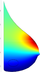 Early Breast Cancer ...