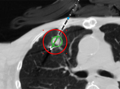 Medtronic Advances Ablation ...